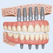 طراحی فول آرچ با exocad | Full Arch Dental Design Workflow